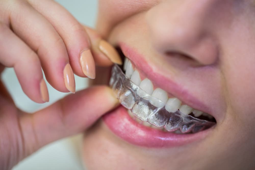 Invisalign (Przezroczyste Nakładki)